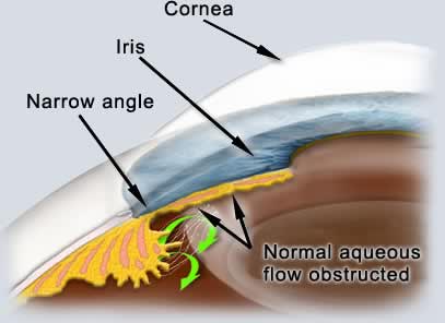 glaucoma 1.jpg